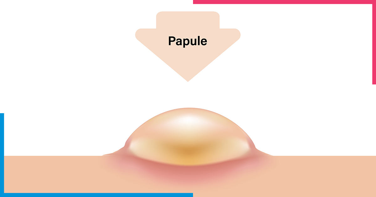 Papule-skiinaceclinic Papule-skiinaceclinic