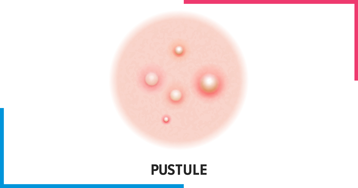 Pustule-skiinaceclinic