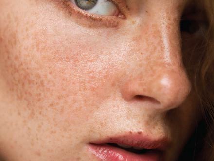 Types-of-acne-skiinaceclinic