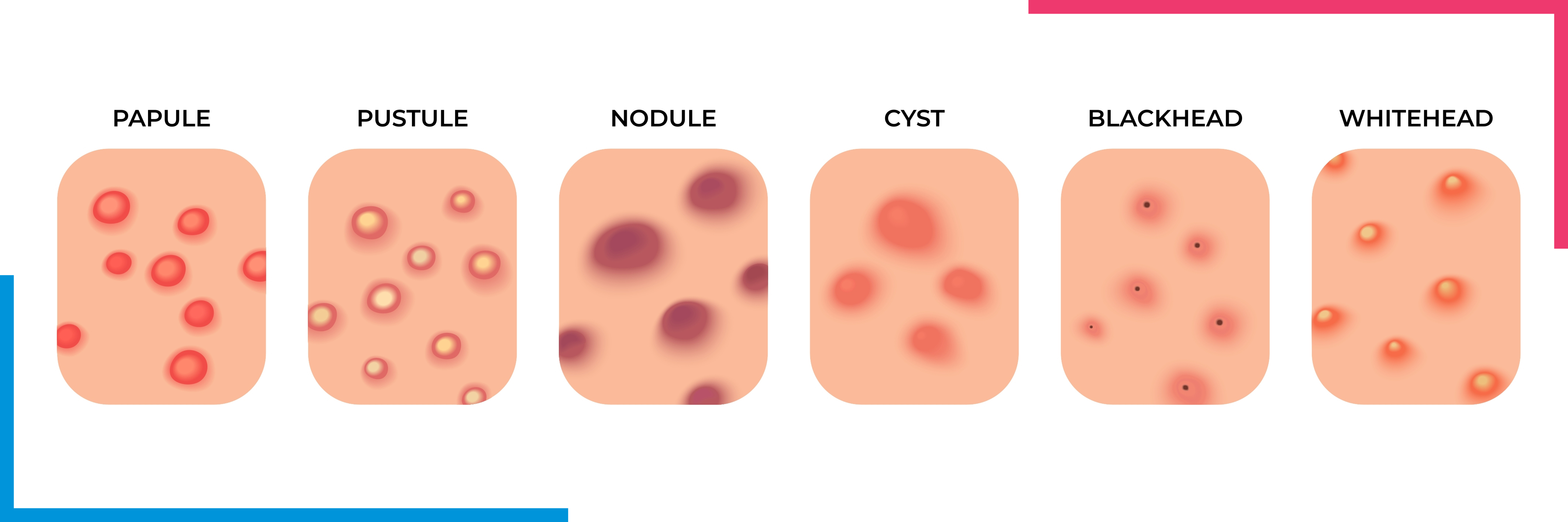 six-Acne-types six-Acne-types