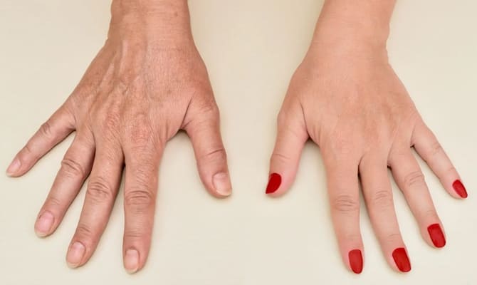 Hand Rejuvenation