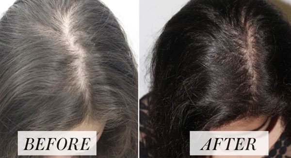 Hair Fall Treatment