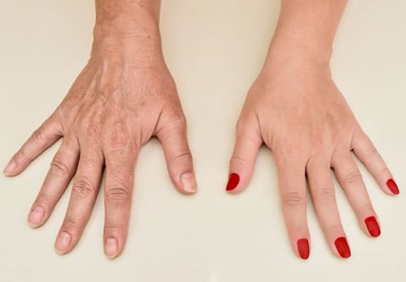 Hand Rejuvenation