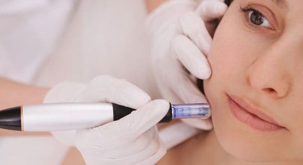 Mesotherapy Treatment