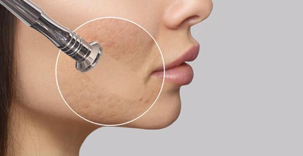 Microdermabrasion