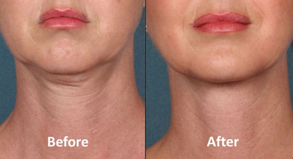 Neck Rejuvenation