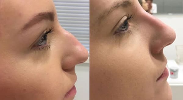 Non-Surgical Rhinoplasty