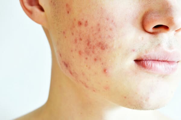  Skin Acne