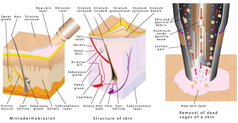 Microdermabrasion